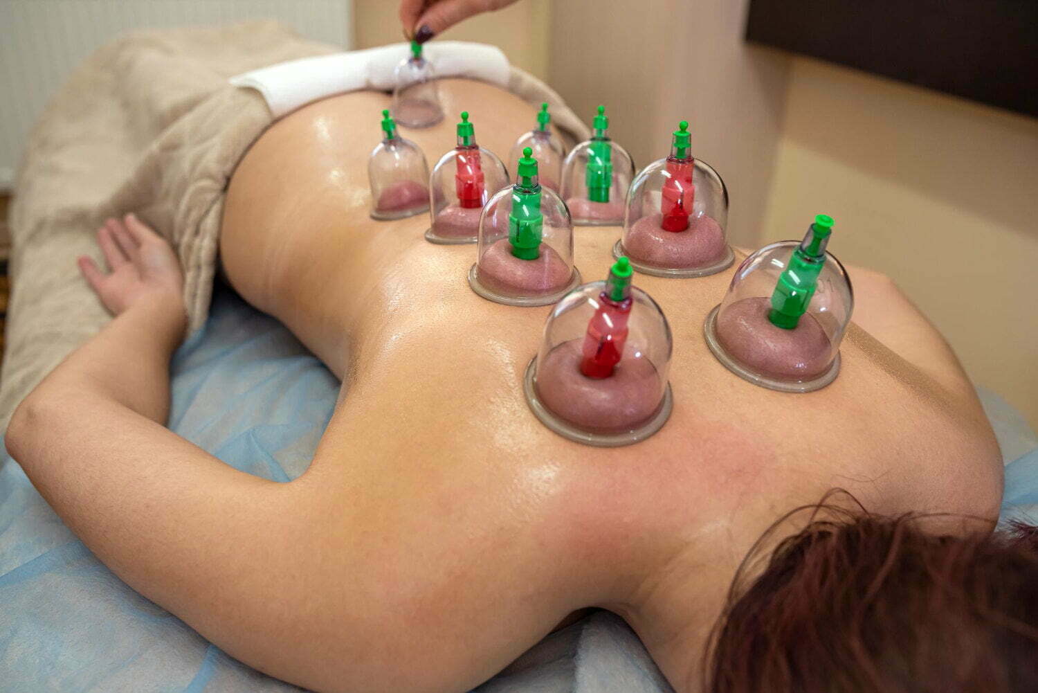 cupping